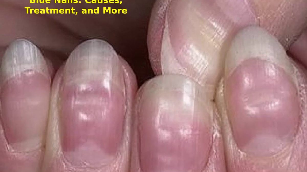 Blue Nails: Causes, Treatment, and More