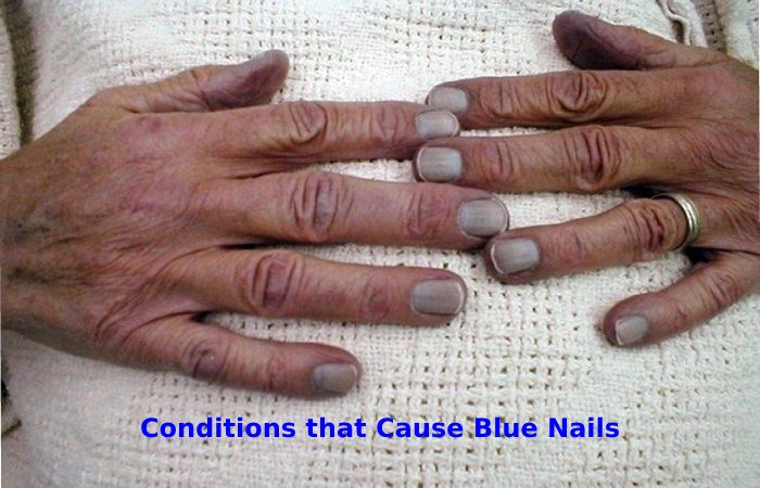 Blue Nails: Causes and Treatment - wide 4