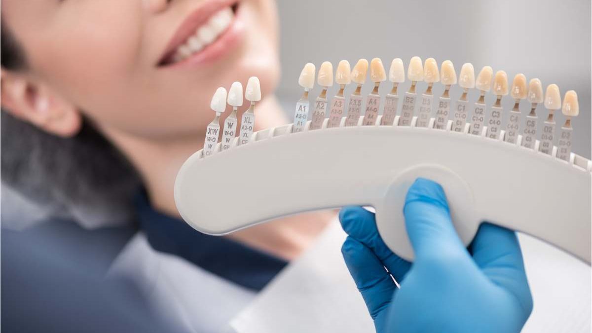 Are Veneers Worth It?