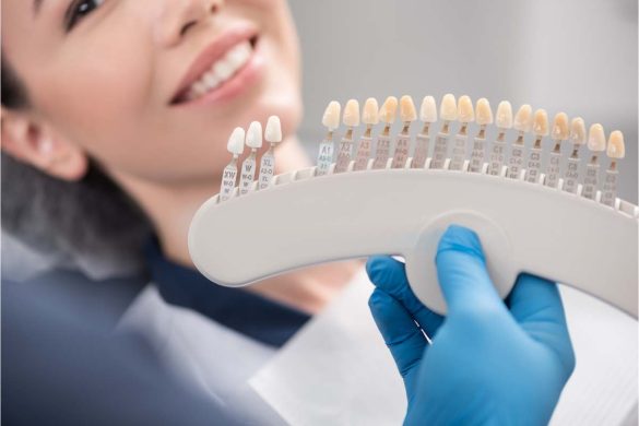 Are Veneers Worth It_