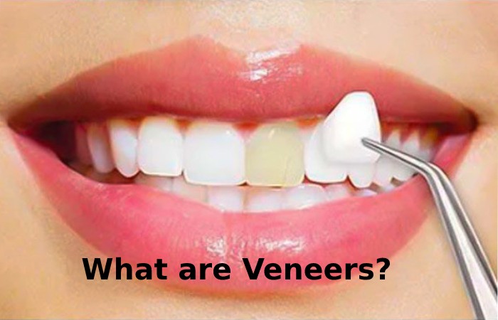 What are Veneers